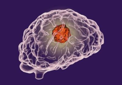 5 Warning Signs of Brain Tumours and Their Treatment