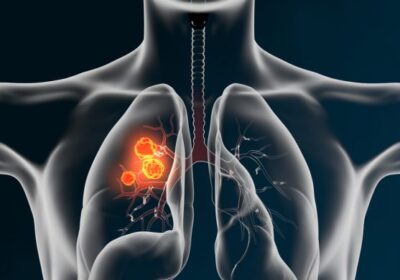 How To Protect Yourself From Lung Cancer